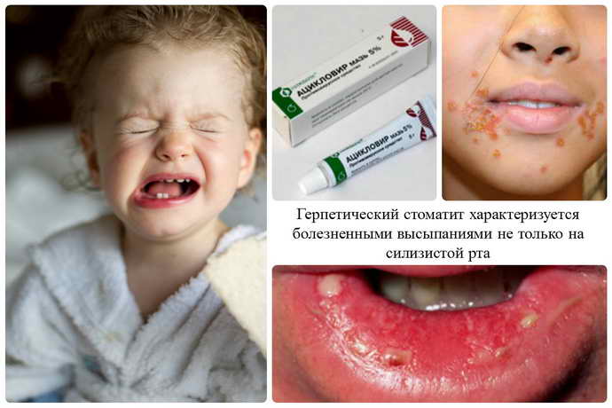 Виды стоматита у детей 3 лет