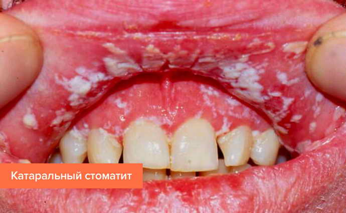 чем лечить вирусный стоматит у ребенка 3 года