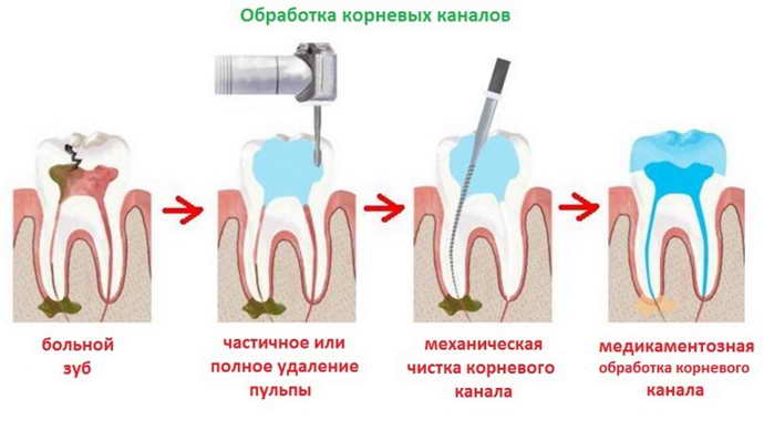 зуб болит под пломбой от пульпы